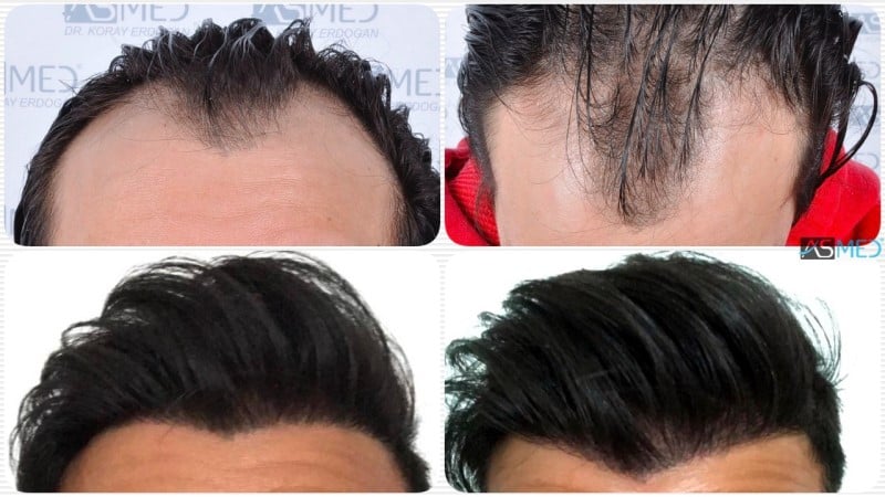 4143-grafts-FUE gallery