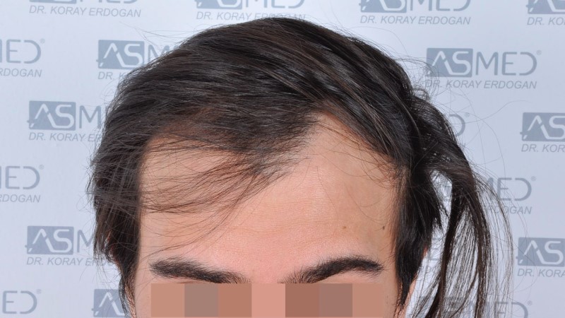 Norwood3 4143-grafts-FUE before 1_V2