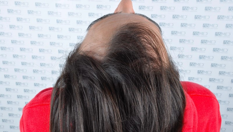 Norwood3 4143-grafts-FUE before 2_V2