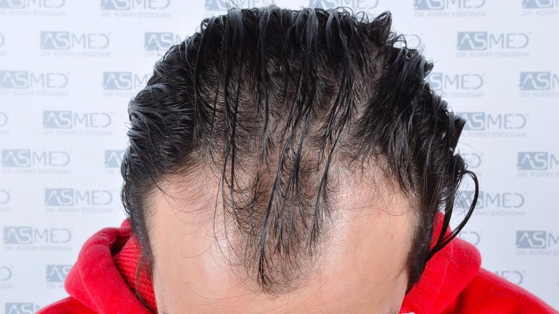 Norwood3 4143-grafts-FUE before 4_V2