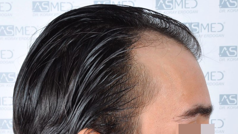 Norwood3 4143-grafts-FUE before 5_V2