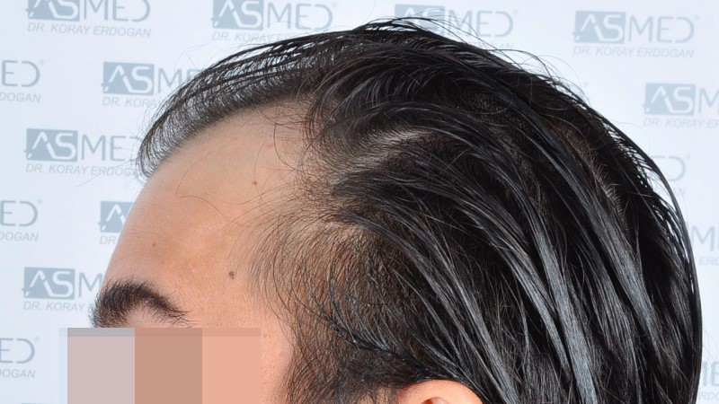 Norwood3 4143-grafts-FUE before 6_V2