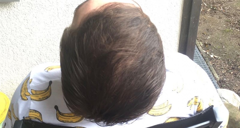 https://www.hairtransplantfue.org/asmed-hair-transplant-result/upload/Norwood3/share/12/6months/IMG-0972.jpg