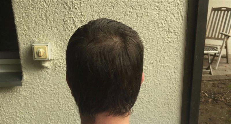 https://www.hairtransplantfue.org/asmed-hair-transplant-result/upload/Norwood3/share/12/6months/IMG-0973.jpg