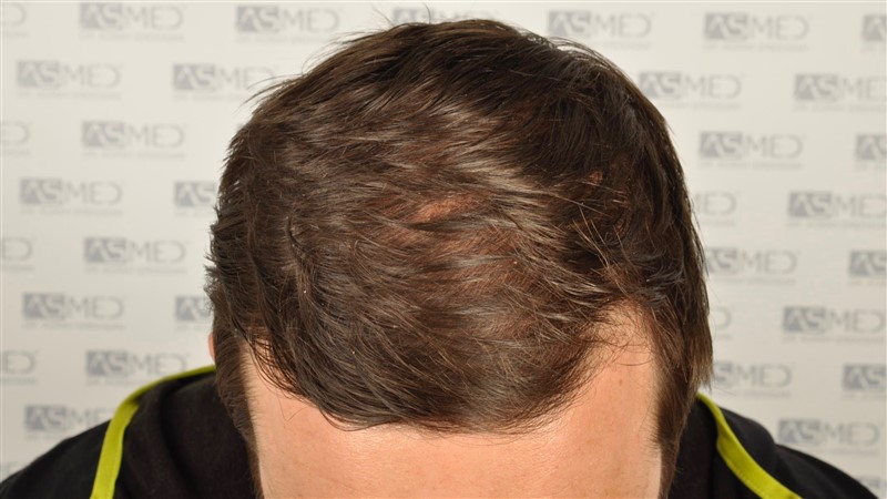 https://www.hairtransplantfue.org/asmed-hair-transplant-result/upload/Norwood3/share/12/before/_DSC4674.jpg