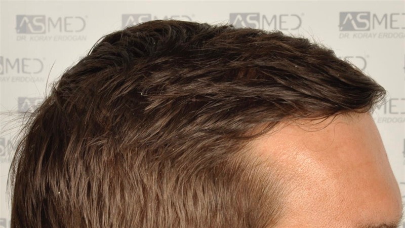 https://www.hairtransplantfue.org/asmed-hair-transplant-result/upload/Norwood3/share/12/before/_DSC4680.jpg
