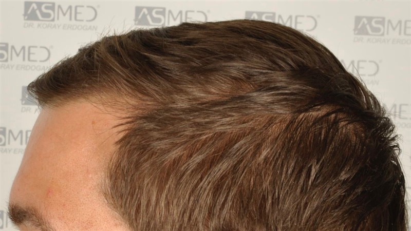 https://www.hairtransplantfue.org/asmed-hair-transplant-result/upload/Norwood3/share/12/before/_DSC4681.jpg
