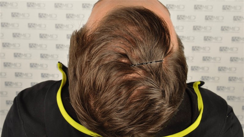 https://www.hairtransplantfue.org/asmed-hair-transplant-result/upload/Norwood3/share/12/before/_DSC4683.jpg