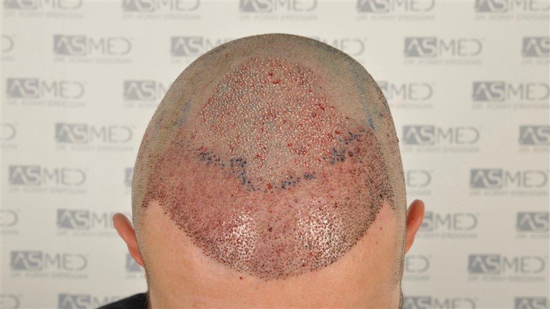 https://www.hairtransplantfue.org/asmed-hair-transplant-result/upload/Norwood3/share/12/operation/_DSC4925.jpg