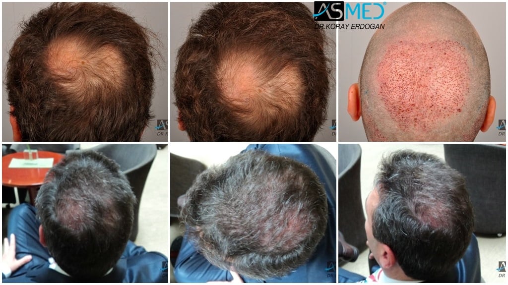 Norwood 4 Hair Transplantation Results | Asmed Hair Transplant Norwood 4 Hair Transplantation Results | Asmed Hair Transplant