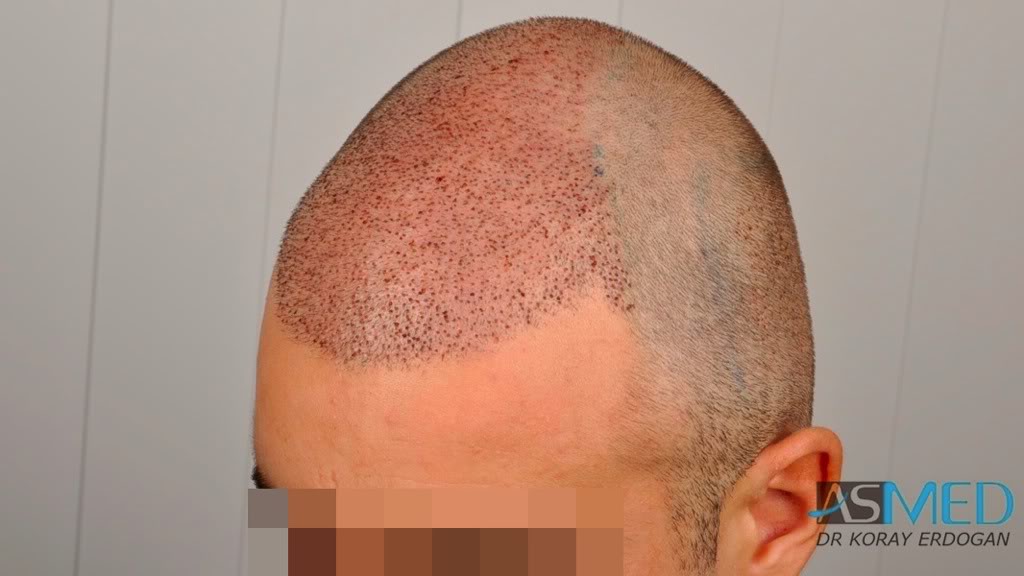 2500 Grafts Fue Norwood 4 Asmed Hair Transplant Results