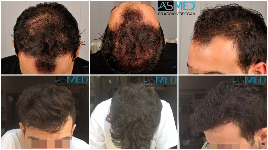 2817-grafts-FUE gallery