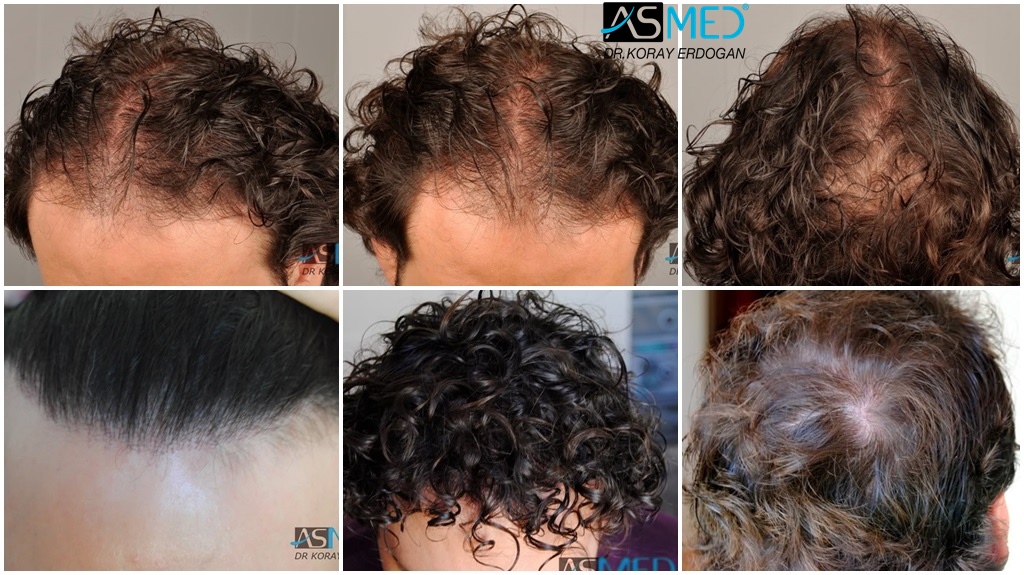 3015-grafts-FUE-repair gallery