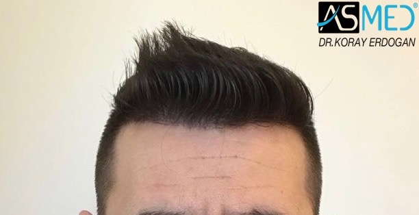 Norwood3v 3025-grafts-FUE 1year 1_new