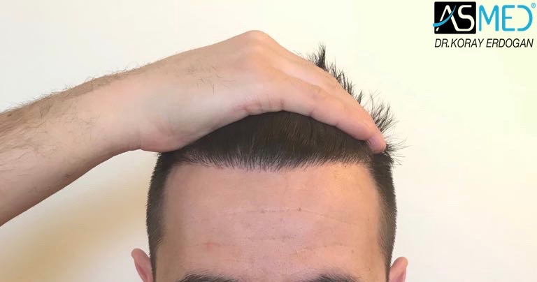 Волосы форум мужчины. Пересадка волос в ASMED доктор Корай Эрдоган.