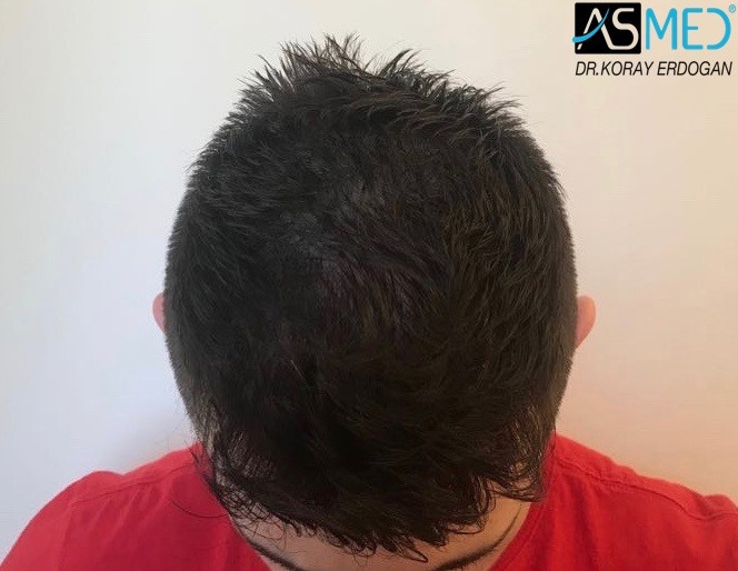Norwood3v 3025-grafts-FUE 1year 3_new