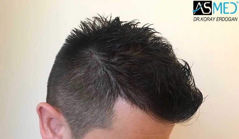 Norwood3v 3025-grafts-FUE 1year 4_new