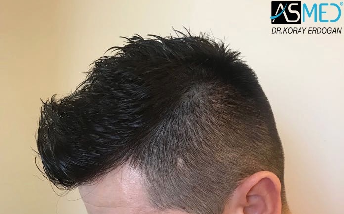 Norwood3v 3025-grafts-FUE 1year 5_new