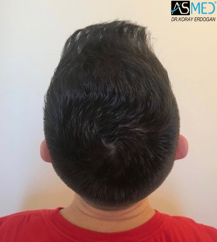 Norwood3v 3025-grafts-FUE 1year 6_new