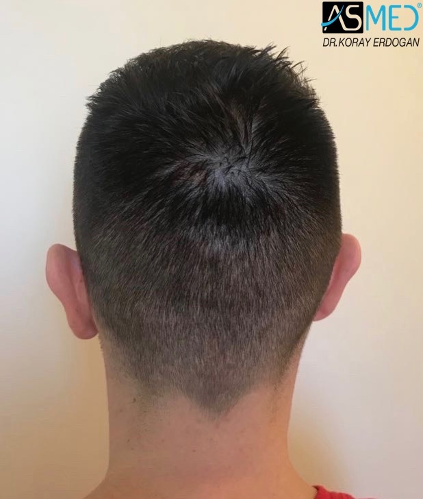 Norwood3v 3025-grafts-FUE 1year 7_new