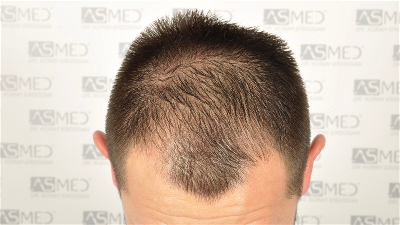 Norwood3v 3025-grafts-FUE before 2
