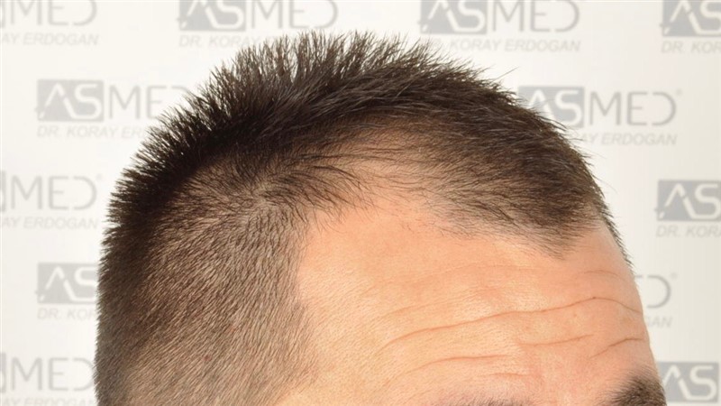 Norwood3v 3025-grafts-FUE before 3