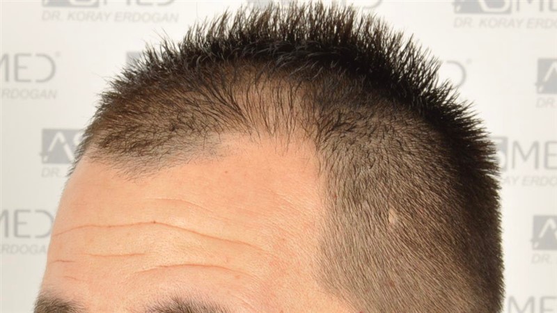 Norwood3v 3025-grafts-FUE before 4