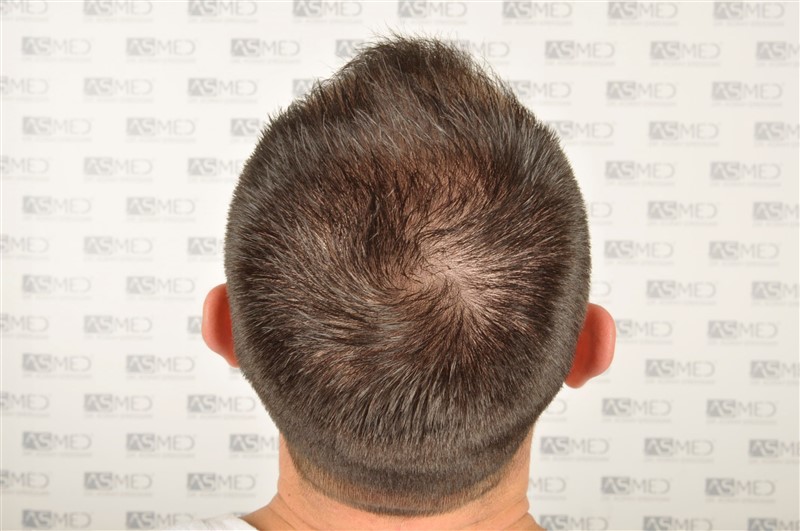Norwood3v 3025-grafts-FUE before 5