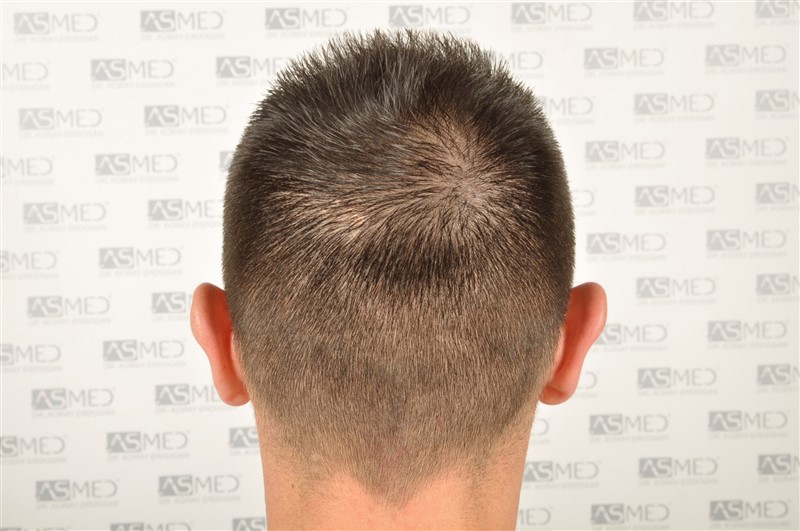 Norwood3v 3025-grafts-FUE before 6
