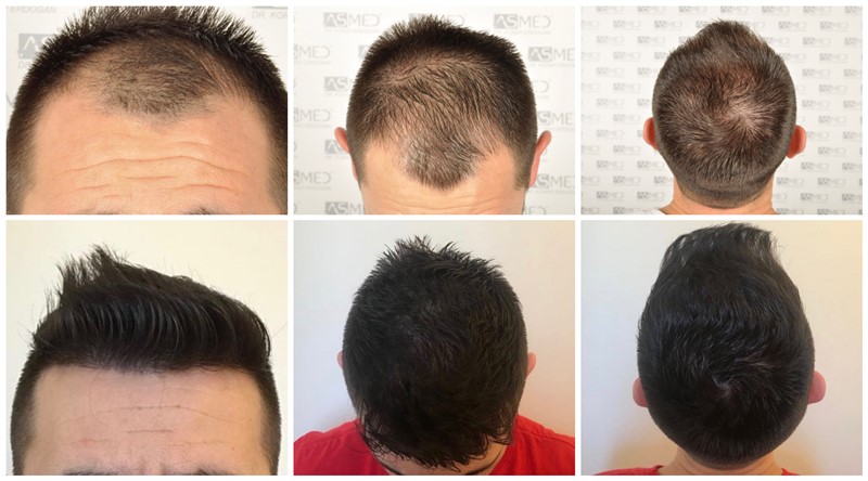 Norwood 4 Hair Transplantation Results | Asmed Hair Transplant Norwood 4 Hair Transplantation Results | Asmed Hair Transplant