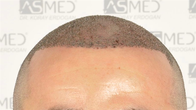 Norwood3v 3025-grafts-FUE operation 1