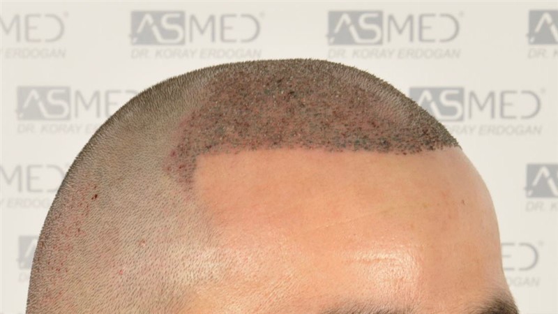 Norwood3v 3025-grafts-FUE operation 3