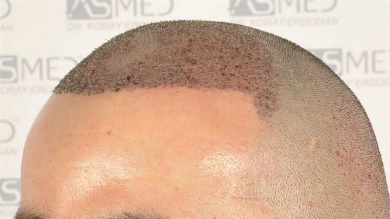 Norwood3v 3025-grafts-FUE operation 4