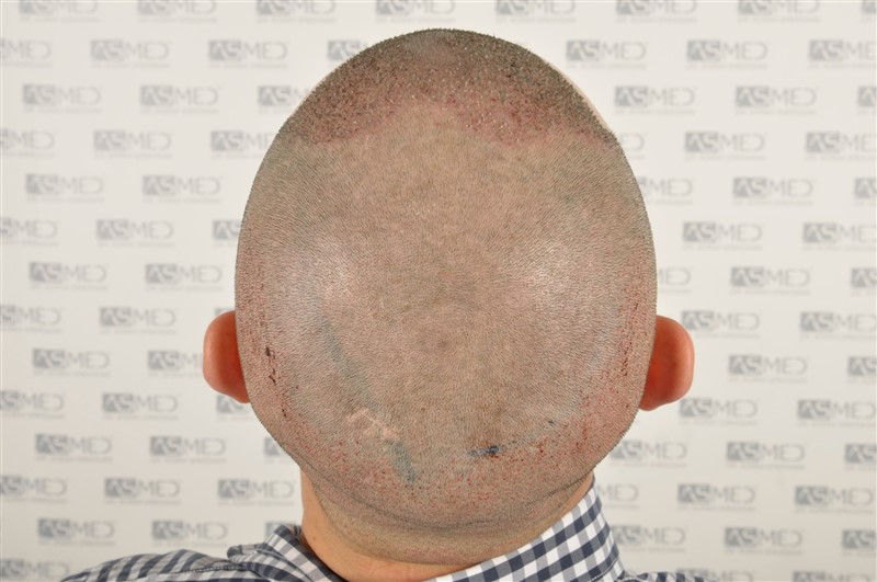 Norwood3v 3025-grafts-FUE operation 5