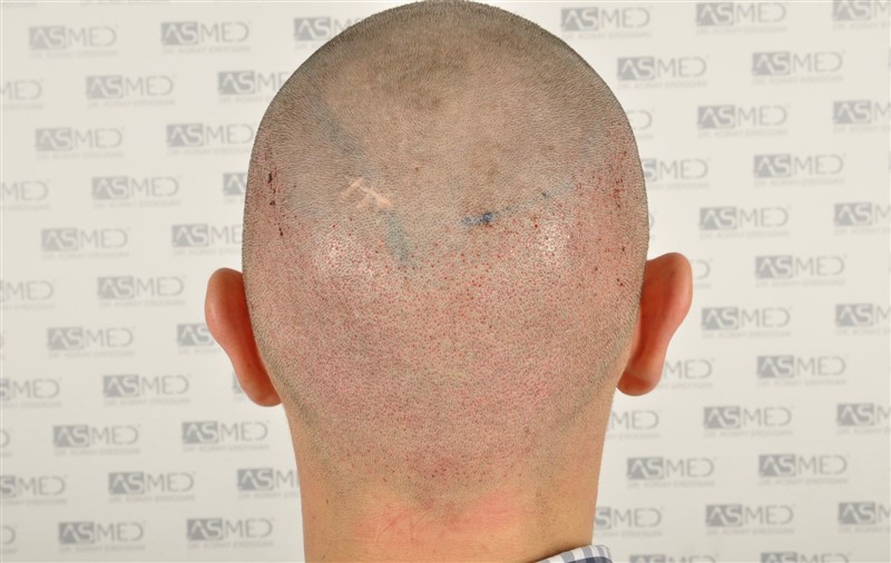 Norwood3v 3025-grafts-FUE operation 6