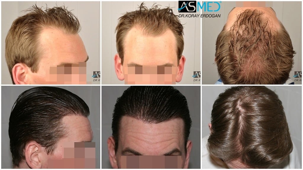 Norwood 4 Hair Transplantation Results | Asmed Hair Transplant Norwood 4 Hair Transplantation Results | Asmed Hair Transplant