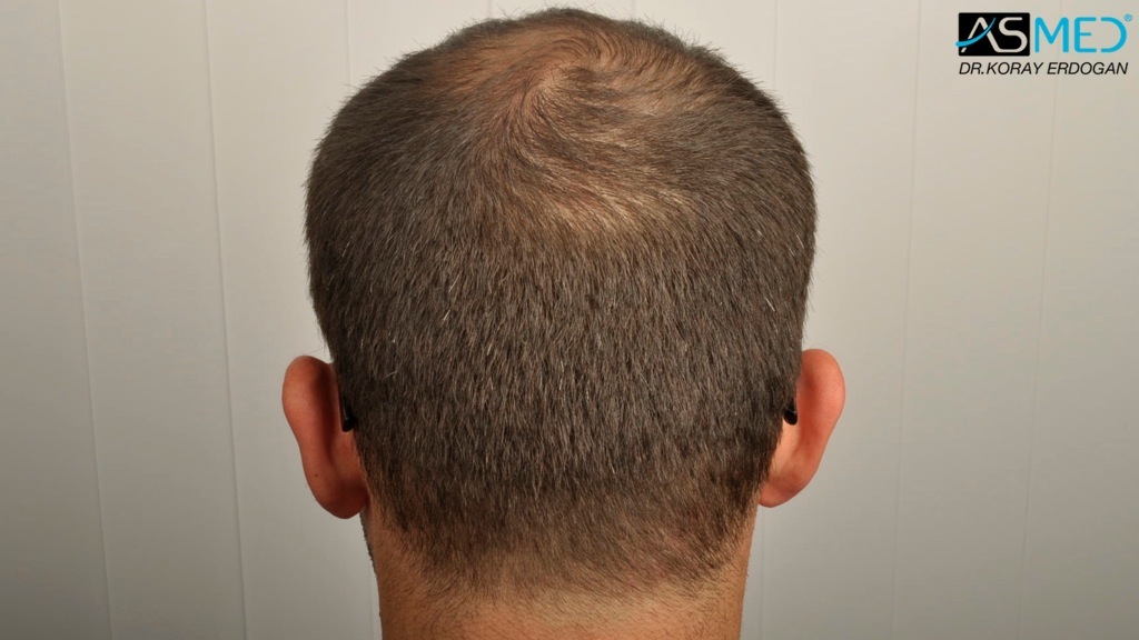 Norwood3v 3850-grafts-FUE file_zps17bc296d
