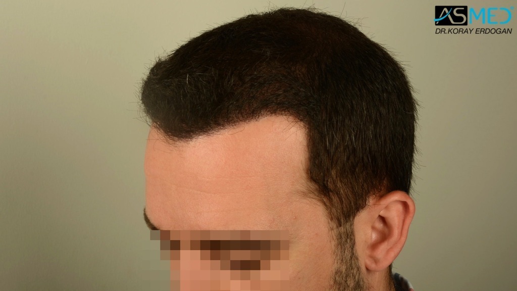 Norwood3v 3850-grafts-FUE file_zps5f4c3749