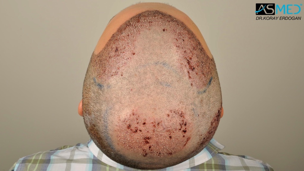 Norwood3v 3850-grafts-FUE file_zps6335e0ab