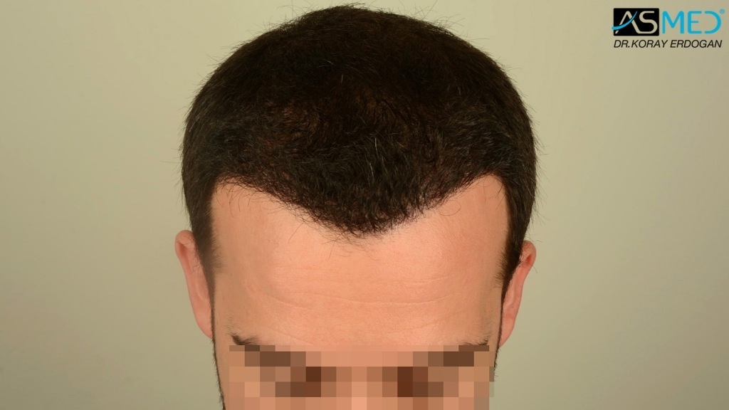 Norwood3v 3850-grafts-FUE file_zps6dc24922