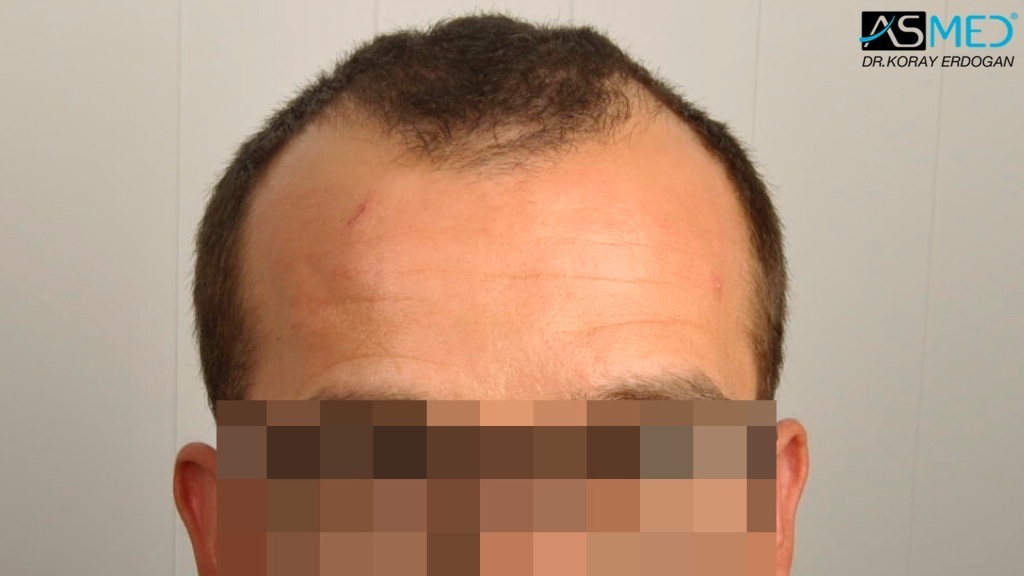 Norwood3v 3850-grafts-FUE file_zps999f80dd