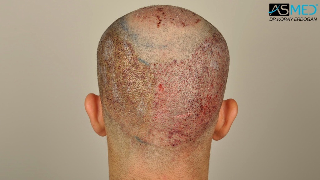 Norwood3v 3850-grafts-FUE file_zpsa3e4fb2c