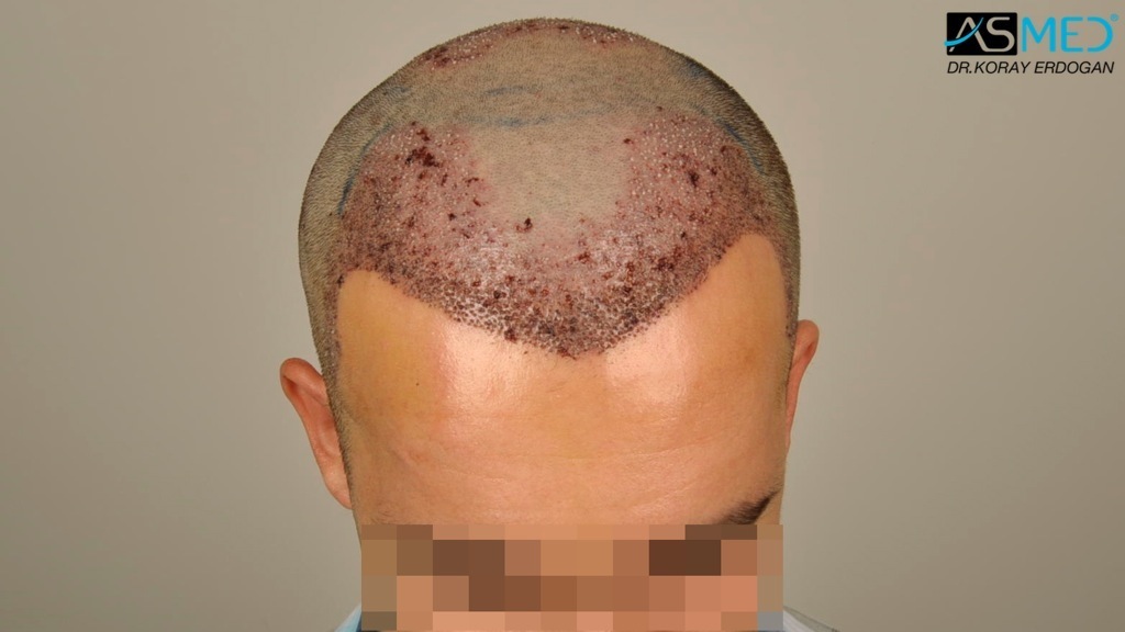 Norwood3v 3850-grafts-FUE file_zpsa737f3a9