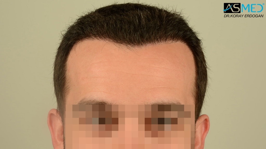 Norwood3v 3850-grafts-FUE file_zpsab99698b