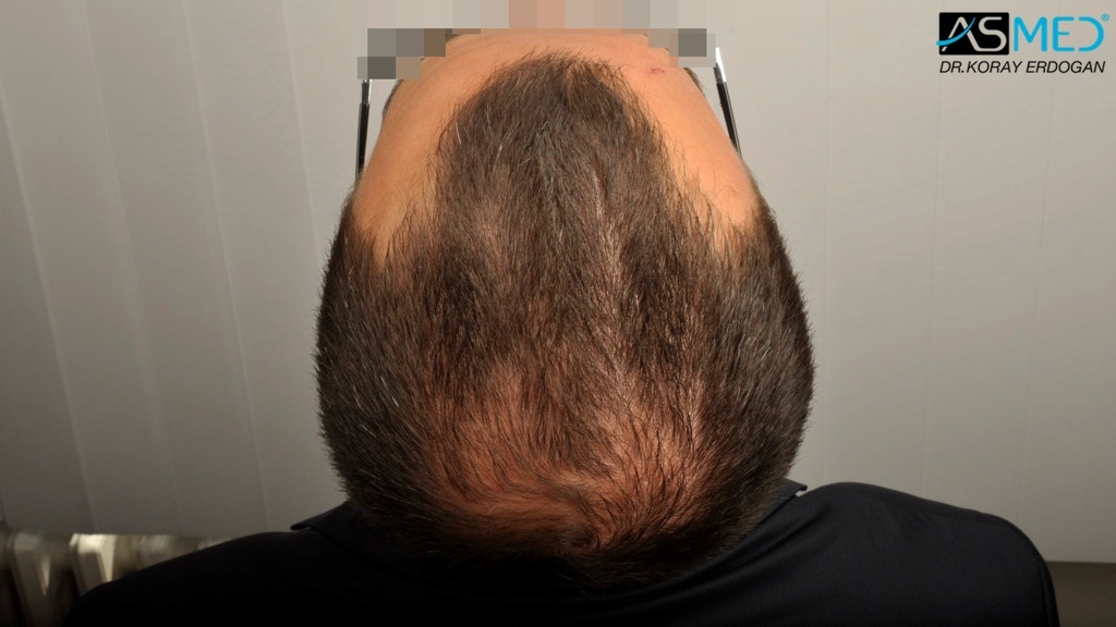 Norwood3v 3850-grafts-FUE file_zpsc237fe96