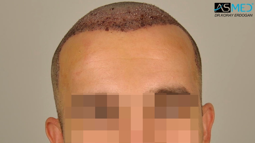 Norwood3v 3850-grafts-FUE file_zpsc413ad16