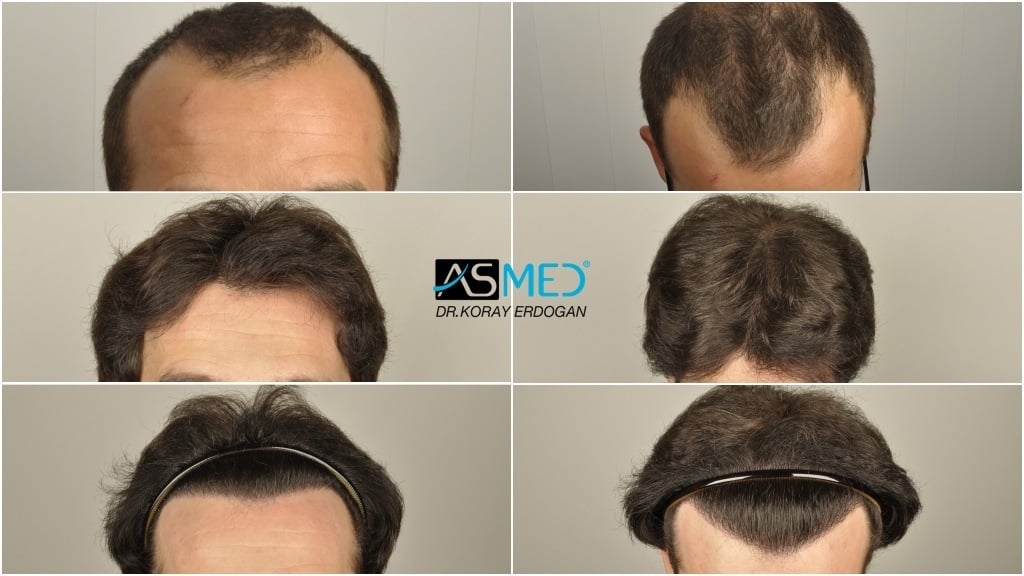 Norwood 4 Hair Transplantation Results | Asmed Hair Transplant Norwood 4 Hair Transplantation Results | Asmed Hair Transplant