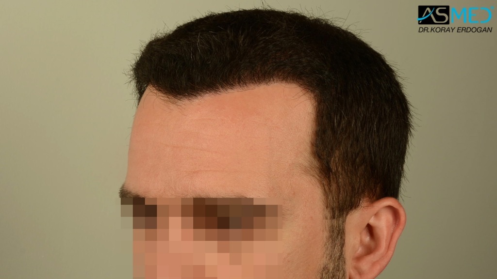 Norwood3v 3850-grafts-FUE file_zpsd2ba6ae6