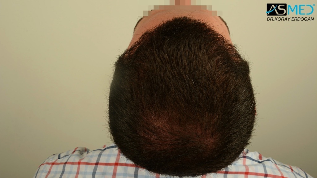 Norwood3v 3850-grafts-FUE file_zpsd5c66bf0
