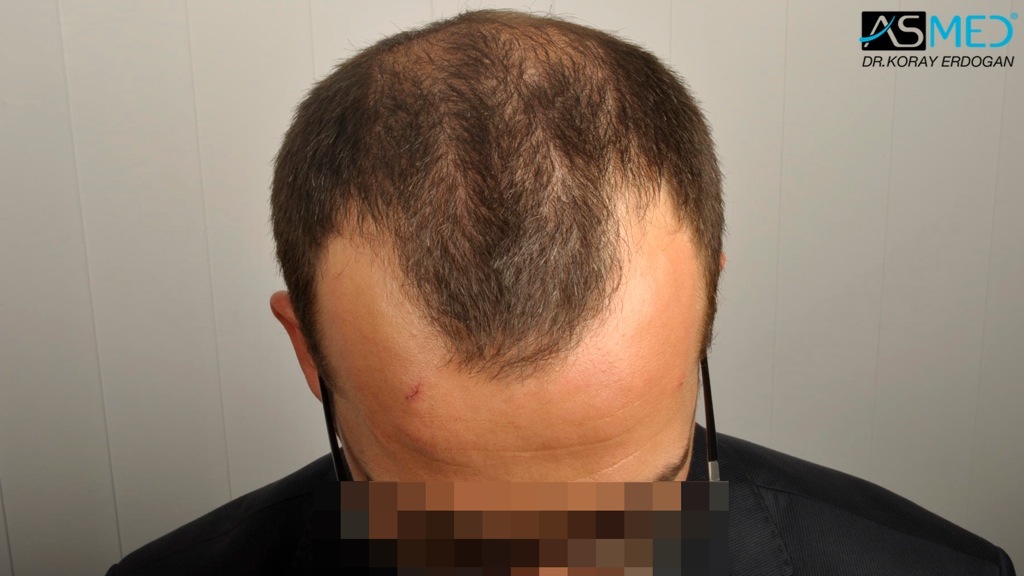 Norwood3v 3850-grafts-FUE file_zpsd9ea9a44